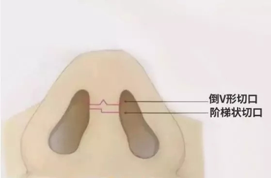 隆鼻手术切口在哪里？才能自然不留疤