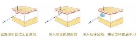 法令纹、川字纹