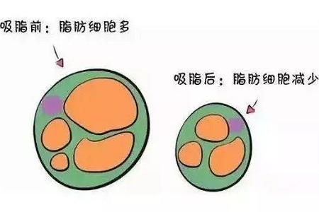 关于吸脂那些不能说的秘密，今天要在这里一次说完！