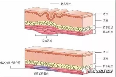 你无法用玻尿酸除掉所有皱纹！