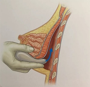 假体隆胸的三种切口应该怎样选择