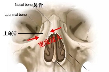 侧面看鼻梁不矮,正面看鼻子却很塌是什么原因？