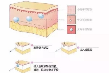 深究玻尿酸有哪些类型和作用