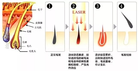 激光脱毛