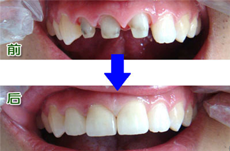 烤瓷牙和全瓷牙有什么区别