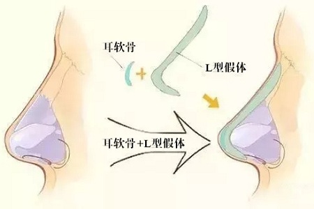 为什么鼻尖不建议用假体