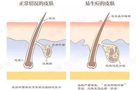 正常情况的毛孔VS易生痘的毛孔