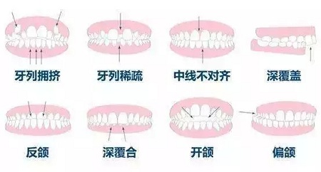 隐形矫正适合的人群