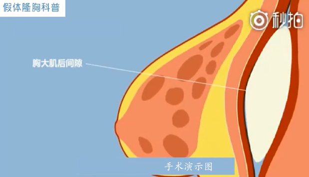 天津和记AG平台怡情娱乐官网10秒带你了解假体隆胸科普