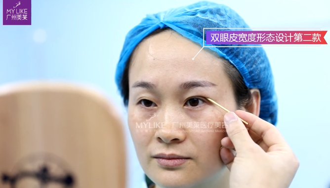 广州和记AG平台怡情娱乐官网双眼皮宽度形状反复确认