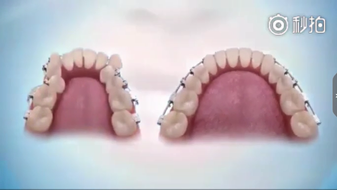 牙齿矫正的过程是什么样的？让苏州和记AG平台怡情娱乐官网告诉你