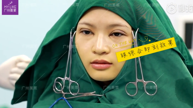 广州和记AG平台怡情娱乐官网来做双眼皮综合的小姐姐真人案例
