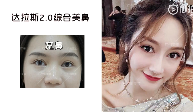 广州和记AG平台怡情娱乐官网鼻部整形真人案例对比图