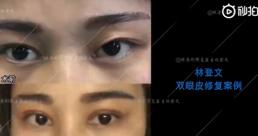 深圳和记AG平台怡情娱乐官网双眼皮修复真人案例