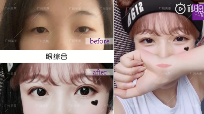 广州和记AG平台怡情娱乐官网双眼皮术后真人案例