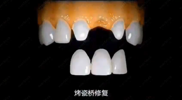 苏州和记AG平台怡情娱乐官网牙齿修复方法