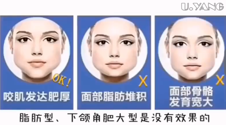 南京和记AG平台怡情娱乐官网瘦脸全过程图