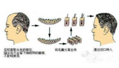 郑州和记AG平台怡情娱乐官网整形医院植发做的好吗