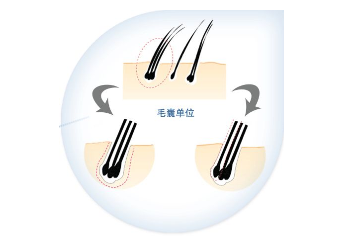 毛发种植