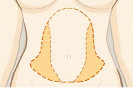 腰腹吸脂瘦身注意事项有哪些