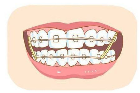 牙齿矫正术后注意什么