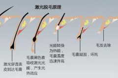 苏州脱毛医院做冰点脱毛的价格多少，对身体有没有伤害