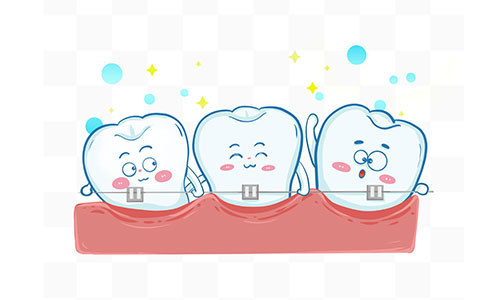 自锁托槽牙齿矫正价格