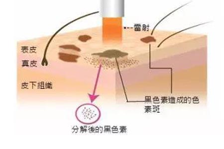 做手术治疗遗传学雀斑需要多少钱