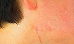 激光治疗疤痕多久能恢复正常肤色，去疤价格大概多少钱