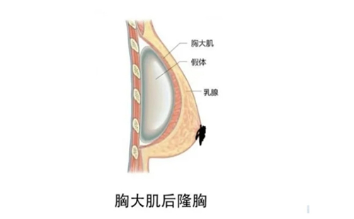 假体隆胸