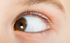 双眼皮手术多久能恢复自然,饮食禁忌有哪些