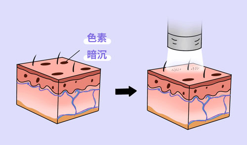 想要嫩肤，应该选择做光电还是水光